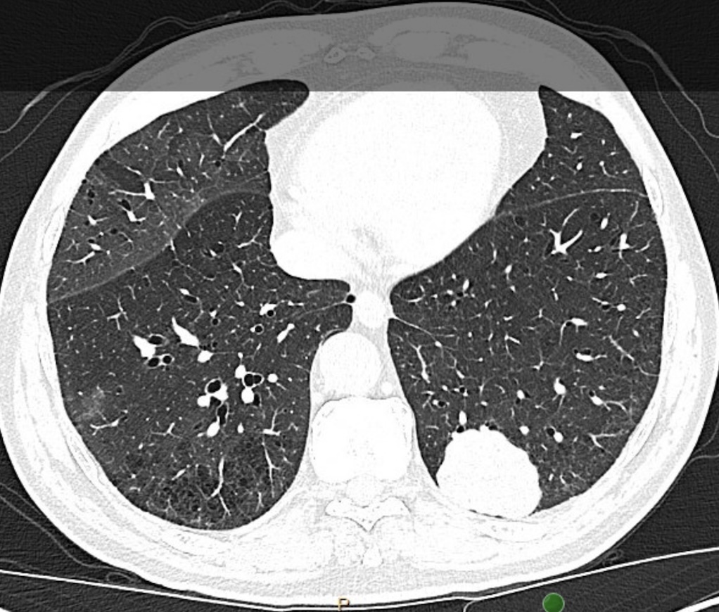 GS_Bronch tweet media