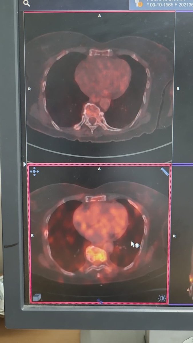 Teclistamab based treatment in a post Transplant Relapse High risk MM, after Daratumumab failure, patient had multiple EMDs at relapse, excellent response For EMDs by Teclistamab.