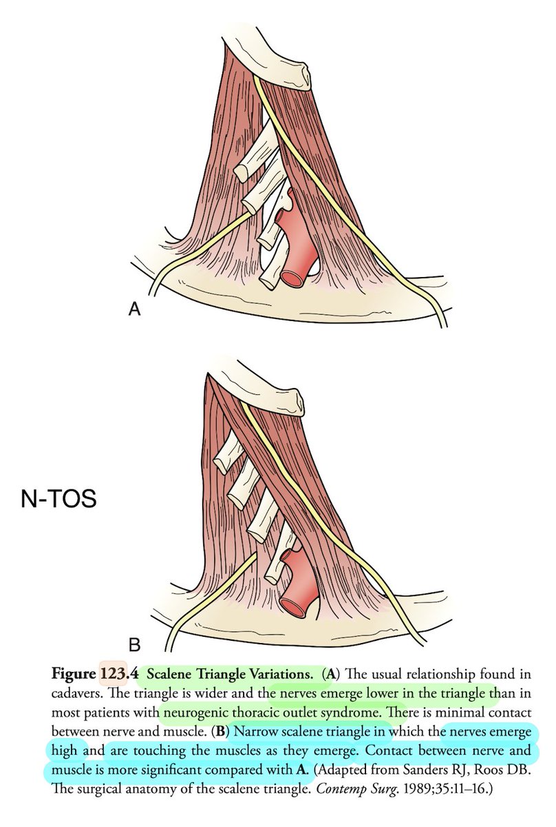 DrManoj_SH's tweet image. #basics
#vascularsurgery

Neurogenic - TOS