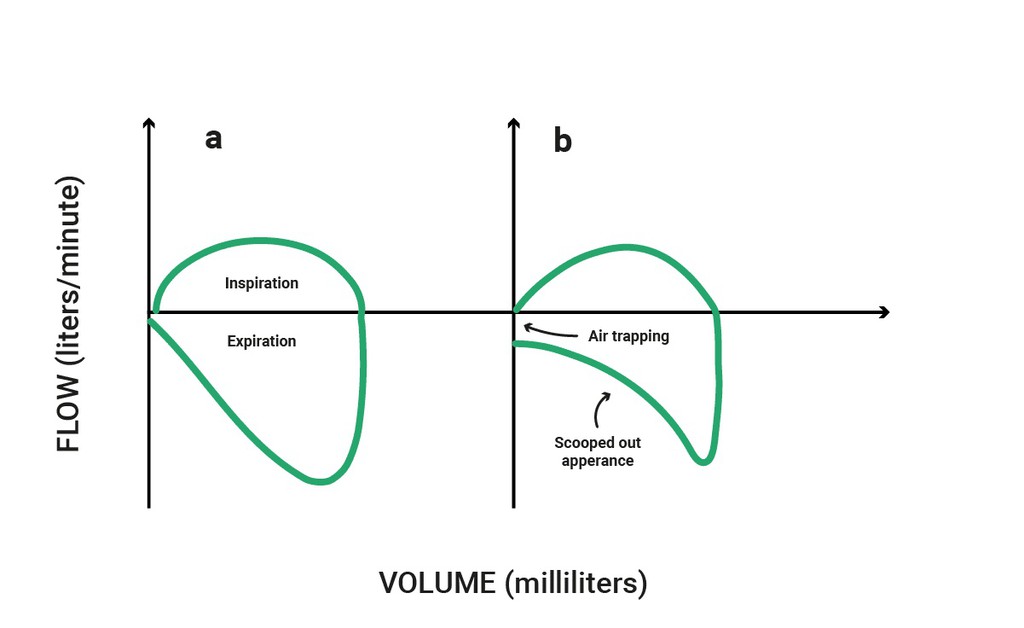 RespiratoryZone's tweet image. The flow-volume loop is a graphical representation used in both mechanical ventilation and pulmonary function testing (PFT) to visualize air movement into and out of the lungs throughout a respiratory cycle. bit.ly/3uvUhKE