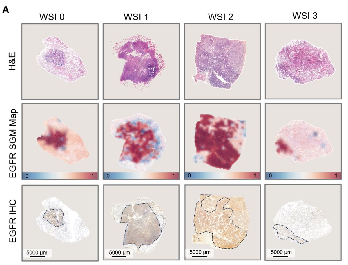 techtechchina's tweet image. 🚨BREAKING - #Tencent unveils its #AI pathology model DeepGEM, capable of predicting lung cancer gene mutations from standard pathology slides within one minute, achieving an accuracy rate of 78% - 99%.