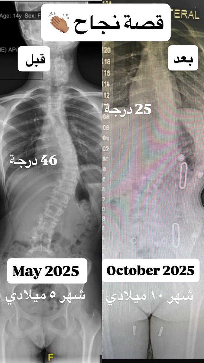 قصص النجاح المبهرة لازالت مستمرة 😍👏🏽

عزيمة ، اصرار، تحدي 

صممت هذي الطفلة انها تحل مشكلتها مع دعم الاهل الكبير لها. بالتزامن مع فريق متخصص وفر لها جبائر متطوره وعلاج طبيعي متخصص صاحبه التزام بالتعليمات والتمارين المنزليه. 

حصلت على نتائج ممتازة والحمدلله 

* ملاحظة: ليست جميع