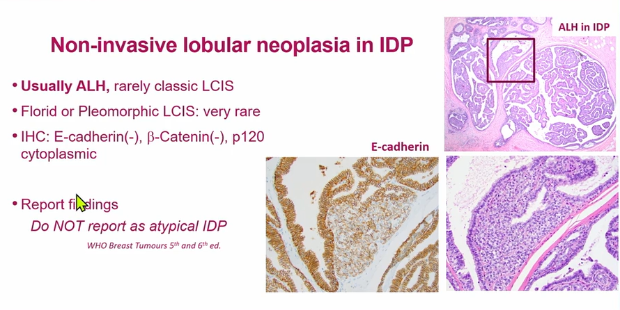 Janiranavarro's tweet photo. Non-invasive lobular neoplasia in intraductal papilloma (IDP)

- Usualmente atypical lobular hyperplasia (ALH), rarely classic LCIS
- Florid or pleomorphic LCIS: Vary rare
- Do not report  as atypical IDP- The term "atypical papilloma" is reserved for intraductal papilloma (IDP) with atypical ductal hyperplasia (ADH), and ADH in IDP is the preferred terminology.

Dr Brogi-Contemporary Issues in Breast Pathology 2025 #PathX #pathology #Breastpath #USCAP