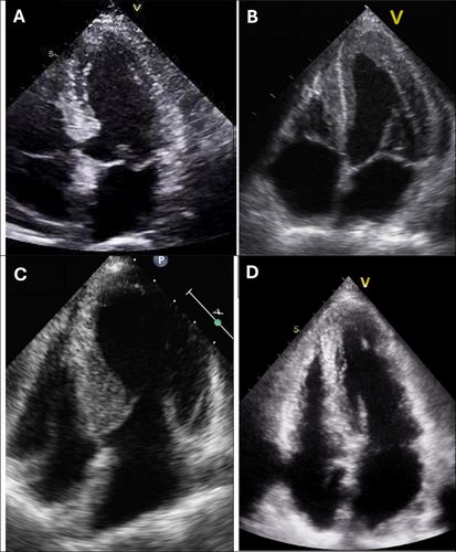 Echocardiographic Features of Cardiomyopathies: A Comprehensive Review
doi.org/10.1111/echo.7…  #Echofirst #iecho #cadiology #echofirst #CardioEd