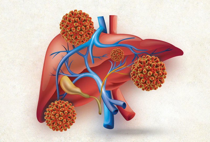 انتبه لهذه العلامات التحذيرية ..

6 علامات على جلدك قد تكون مؤشراً لمشاكل في الكبد

🔺اليرقان:

اصفرار ملحوظ في الجلد وبياض العينين (علامة تستدعي استشارة طبية فورية)

🔺أوردة عنكبوتية: 

ظهور شعيرات دموية حمراء صغيرة ومتفرعة على الوجه أو الصدر

🔺حب شباب مستمر :

حبوب متكررة لا