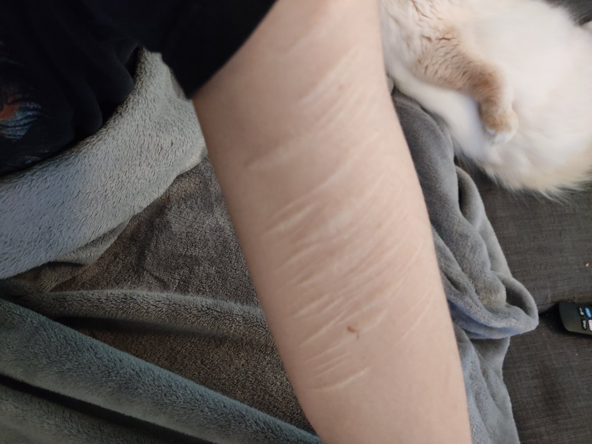 Wer hätte gedacht, dass es zu SVV führen kann, wenn man an Dysphorie leidet und seinen Körper hasst? *insert surprised pikachu meme*

Ich habe btw auch solche Narben. Habe ich viele Jahre aus Scham versteckt, heute trage ich sie mit Stolz, weil ich seit 8 Jahren "clean" bin 💪😎