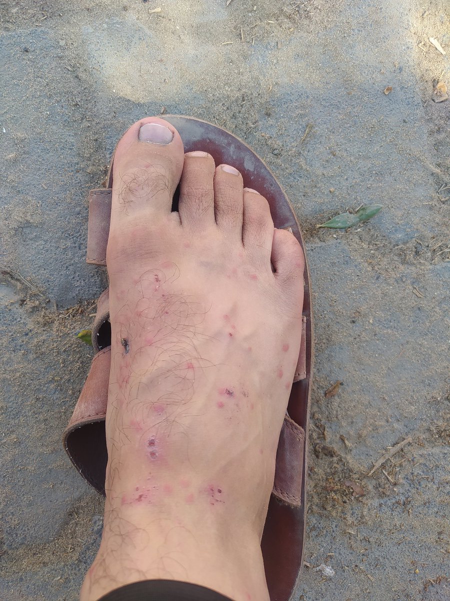 This is what the mosquito did to me after I returned to northern Gaza. 

There is not even a drop of water there

3 replies — even dots — can break the silenence3
 
Please donate :
spot.fund/446dkczsc