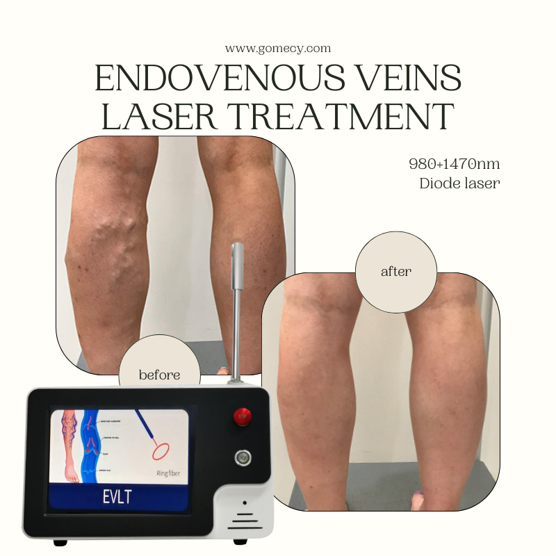 NGomecy9639's tweet image. Revolutionize vein care with dual-wavelength EVLT laser technology.
980+1470nm diode laser = less pain, fast recovery, long-lasting results.
Trusted by clinics, loved by patients.
📧 natasha@gomecy.com | 🌍 gomecy.com
#EVLT #LaserVeinTreatment #Gomecy