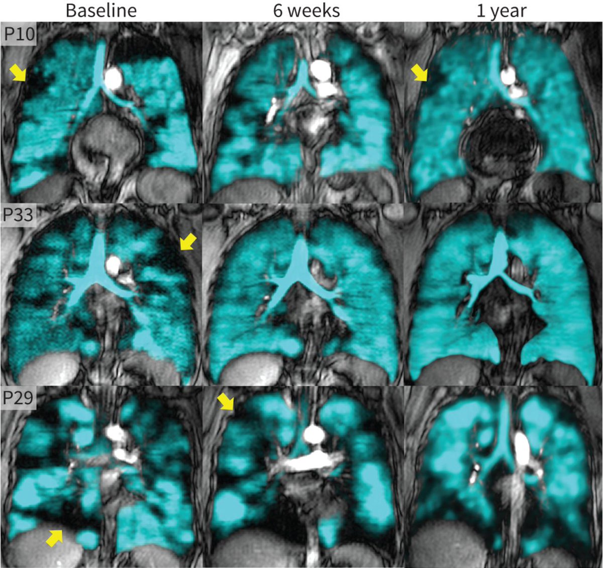 ERJOR: In patients with moderate–severe asthma, single-inhaler fluticasone furoate/umeclidinium/vilanterol resulted in improved airway function, airway mucus occlusions, lumen area and total airway count, consistent with the reversal of airway remodelling. bit.ly/421XXk0
