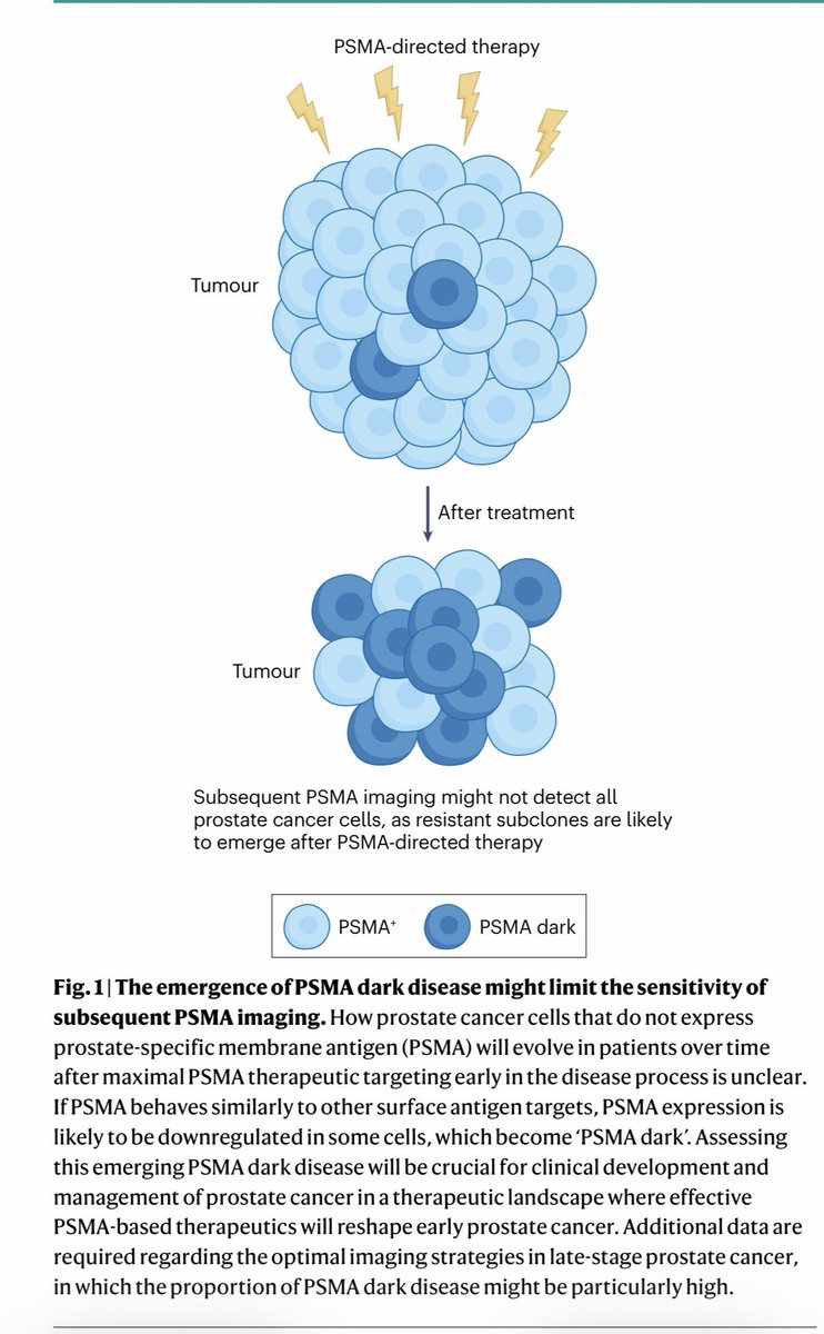 Dr_RaviMadan's tweet image. As #ESMO25 brings new data on #PSMA it may be time to consider what happens when you target a surface antigen in cancer. How will that impact diagnostic sensitivity of that target?
#PSMAdark
#ProstateCancer #theranostics
@melissaabel20 et al @NatRevUrol
rdcu.be/eKNQe