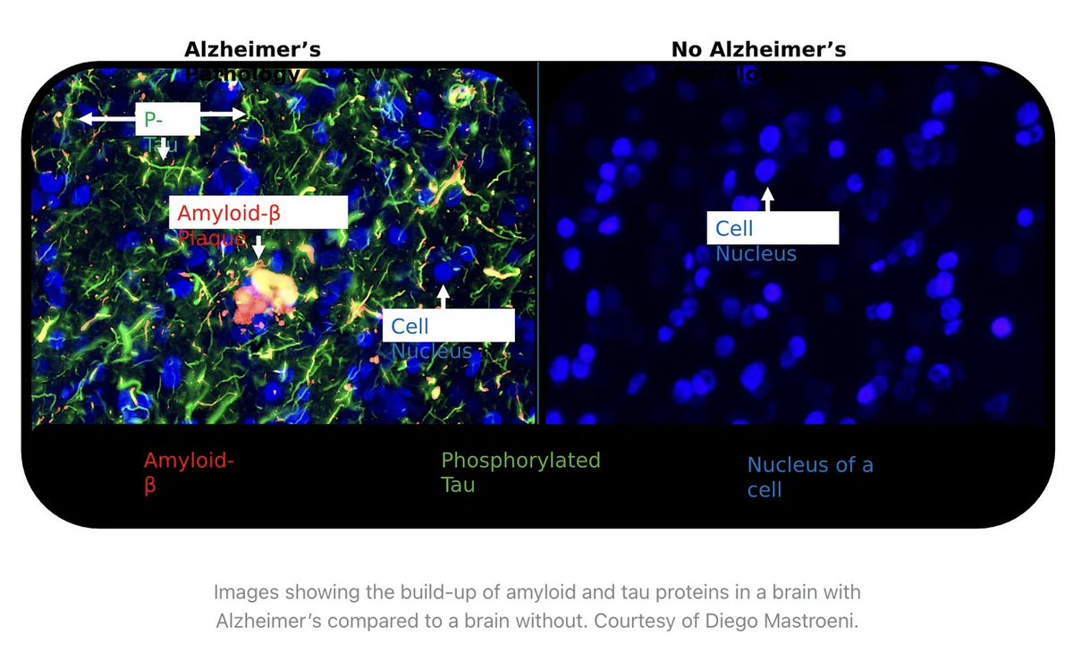 progressntwrk's tweet image. 🤔What increases your risk of dementia?

🧠Managing editor @asumediaent, @MiaAArmstrong, sat down with Diego Mastroeni,  an expert on Alzheimer’s and neurodegenerative diseases, as well as an associate research professor @asuSOLS and a researcher at @ASUBiodesign, to talk about…