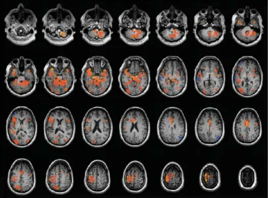 Un cas rarissime de #synesthésie émotionnelle après un #AVC
Neuf mois après son AVC hémorragique siégeant dans une partie du thalamus gauche, ce patient commence à ressentir de curieuses expériences sensitives de nature émotionnelle.
lemonde.fr/blog/realitesb… [Rediff] #emotions