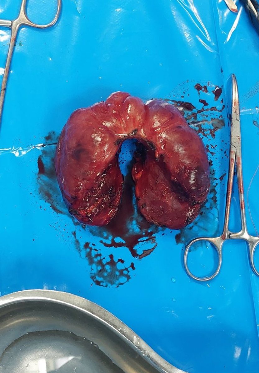 caiser_52's tweet photo. Total thyroidectomy https://t.co/VAdM4ZXrQS