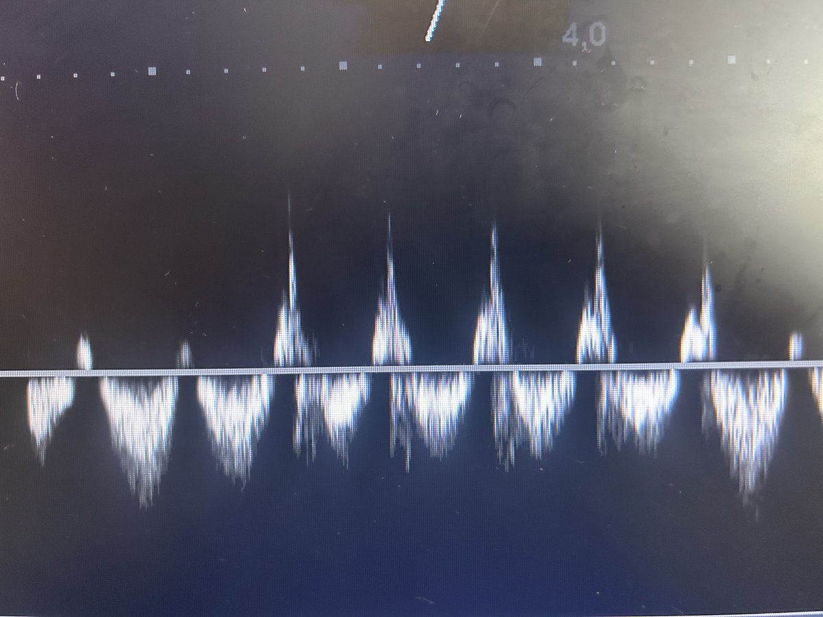 intensivaev's tweet image. Venous or arterial flow? #POCUS #POCUSfirst #FOAMED