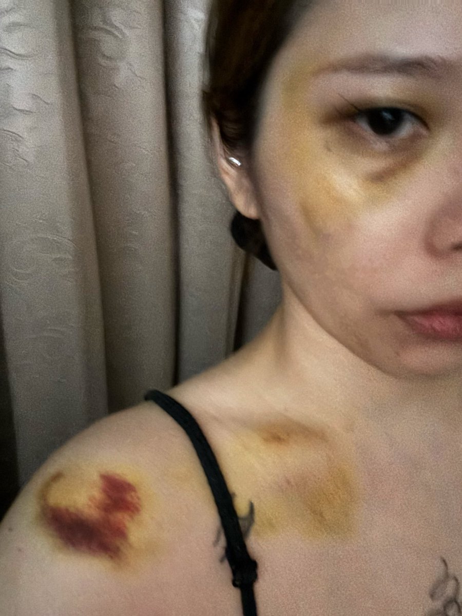 上禮拜無前兆的暈倒三次⋯
因為是瞬間暈倒沒前兆了
所以正面摔手也沒扶🤣
超像被揍的好好笑

https://t.co/mto43N865r更新☺️☺️☺️ https://t.co/l7aSCXPIqT
