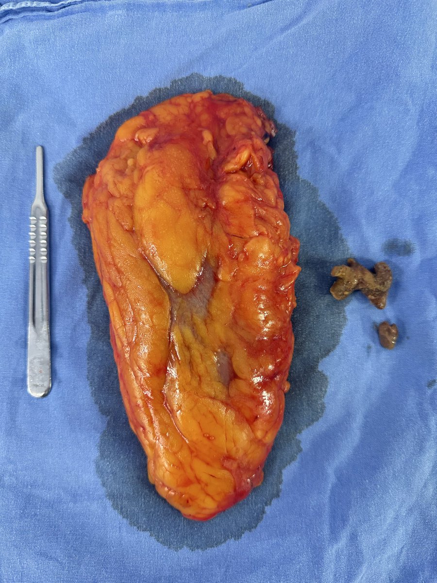 un_tal_urologo's tweet photo. Realizamos nefrectomía laparoscópica por exclusión renal derecha (riñón que dejó de funcionar) secundario a LITIASIS.

Recuerden que la UROLITIASIS crónica y no tratada extra al dolor e infecciones que puede desencadenar también puede dañar el riñón a tal grado de dejarlo sin función de forma total.

Hidrátense y cuiden esos riñones 👍🏻