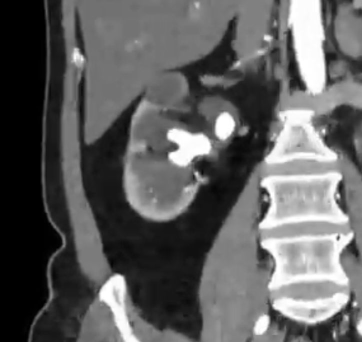 un_tal_urologo's tweet photo. Realizamos nefrectomía laparoscópica por exclusión renal derecha (riñón que dejó de funcionar) secundario a LITIASIS.

Recuerden que la UROLITIASIS crónica y no tratada extra al dolor e infecciones que puede desencadenar también puede dañar el riñón a tal grado de dejarlo sin función de forma total.

Hidrátense y cuiden esos riñones 👍🏻
