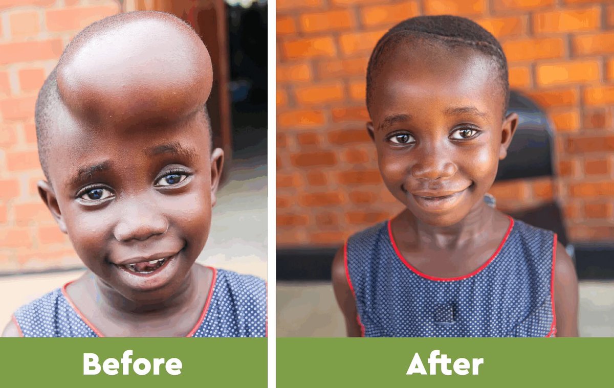 “I want to thank everyone who helped fund Mercy’s surgery. Without your kindness, we wouldn’t have the chance to give her a life free from pain and fear.” Phiona, Mercy’s aunt &amp; caregiver. You can run that hope forward in 4 days. Register here: bit.ly/4ndlXJY
<a href="/nbs/">NBS</a>