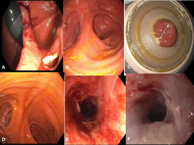 ASGEendoscopy's tweet image. Editor's Choice: In this Review Article, Gursimran S. Kochhar and Partha Pal address "Endoscopy in inflammatory bowel disease: what every endoscopist should know." Find it here: hubs.ly/Q03LW0Bx0. #GITwitter #GIE #GIEJournal
