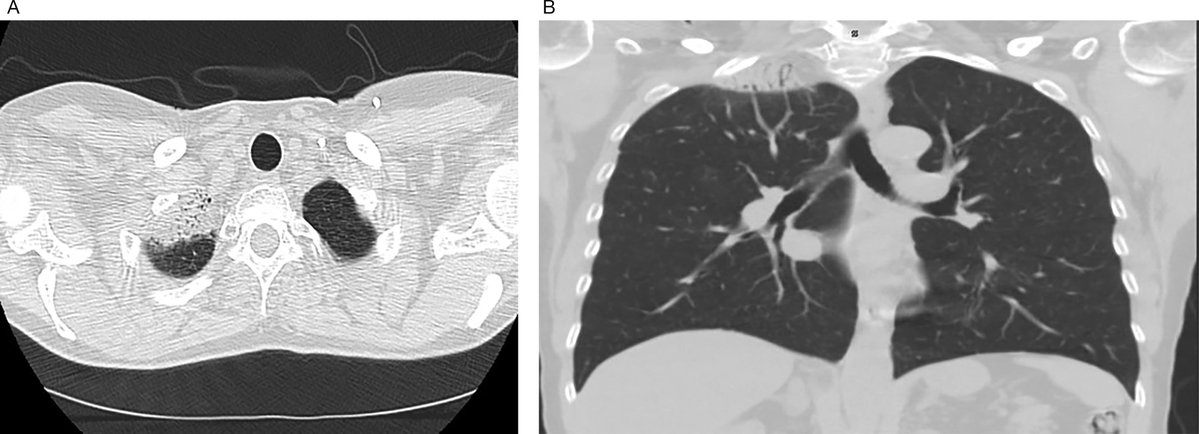 Applied_RadOnc's tweet image. Case Study: Radiation Therapy-Induced Toxicity in a Breast Cancer Patient With Variance of Unknown Significance in the Ataxia Telangiectasia Gene
🔗 ow.ly/kZN750XaMkC
⚠️ The following content contains medical images that may be disturbing to some viewers. Viewer…