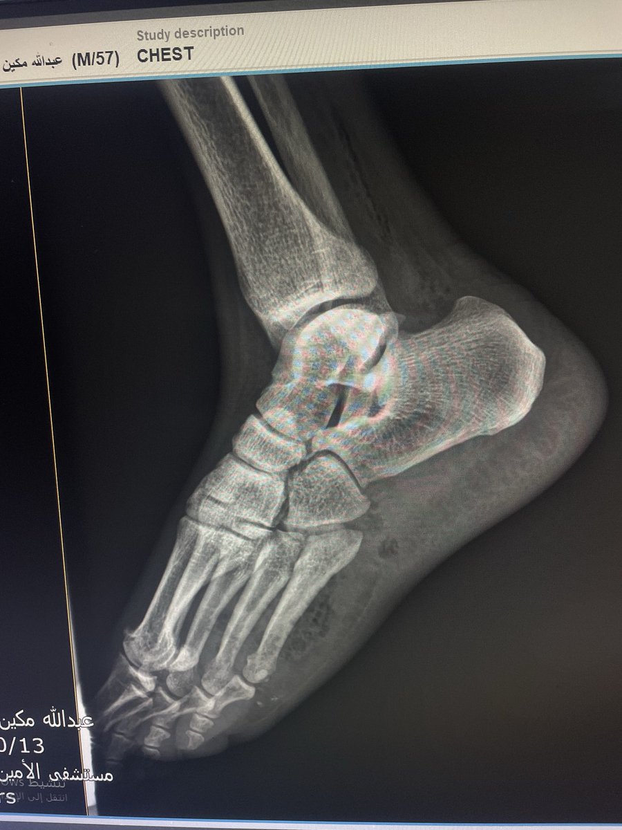 EchoTech_4's tweet image. a 58 years male came with a diabetic foot And diffuse foot swelling 

Duplex U/S requested and done 
Your opinion?

#EchoTech