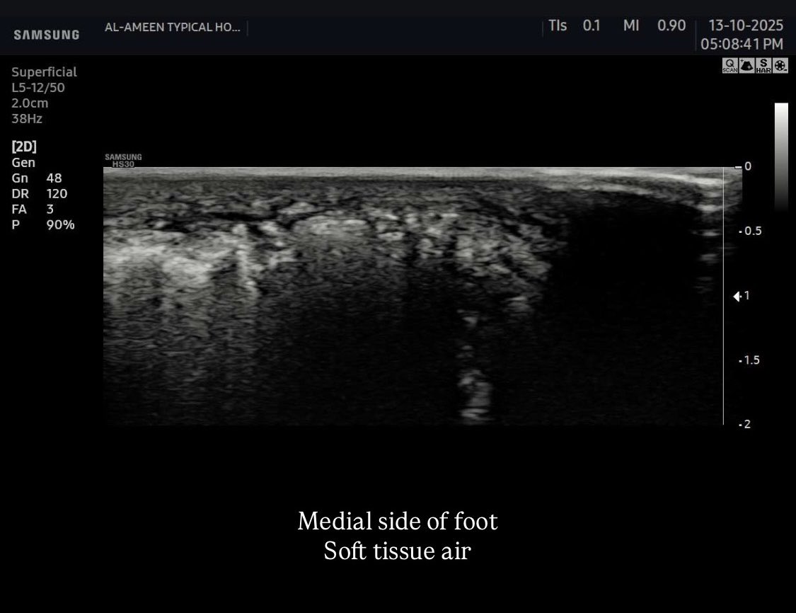 EchoTech_4's tweet image. a 58 years male came with a diabetic foot And diffuse foot swelling 

Duplex U/S requested and done 
Your opinion?

#EchoTech