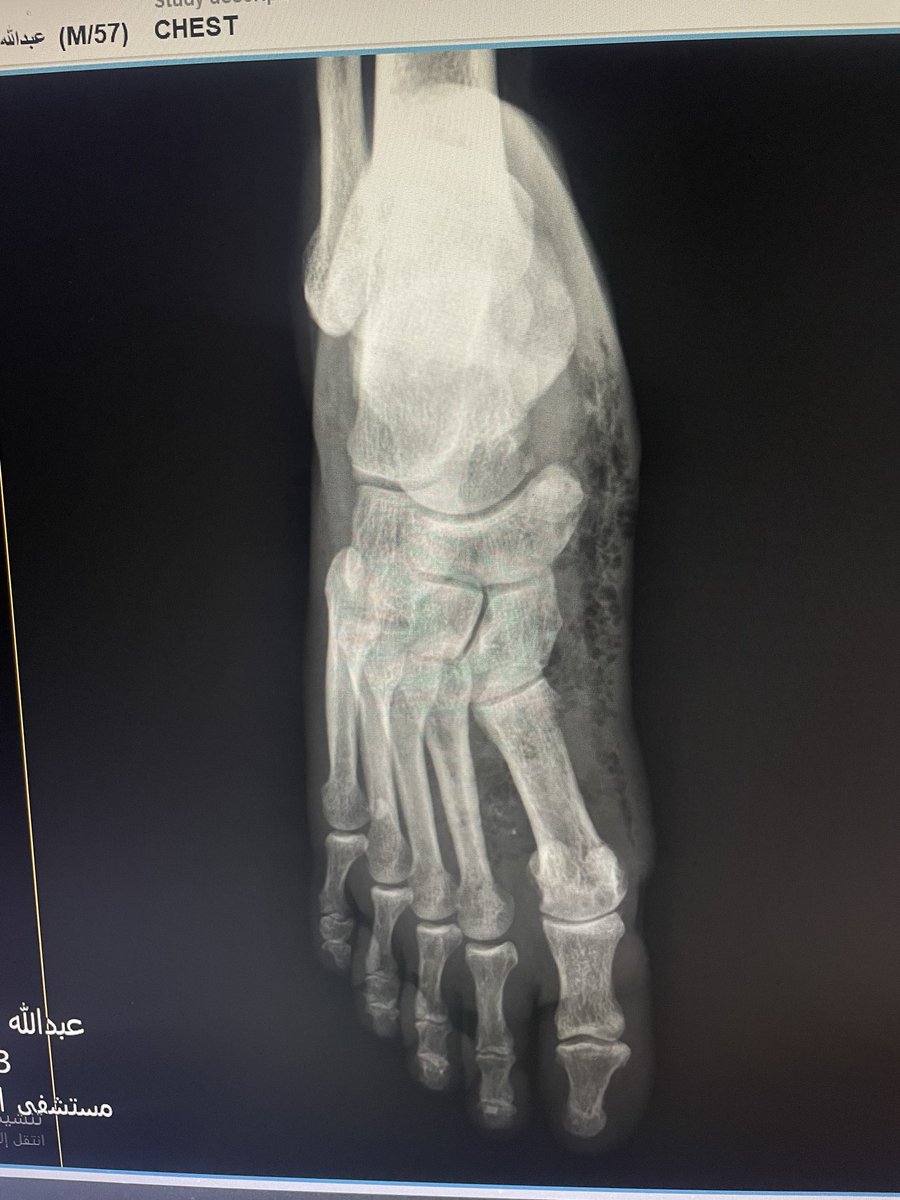 EchoTech_4's tweet image. a 58 years male came with a diabetic foot And diffuse foot swelling 

Duplex U/S requested and done 
Your opinion?

#EchoTech