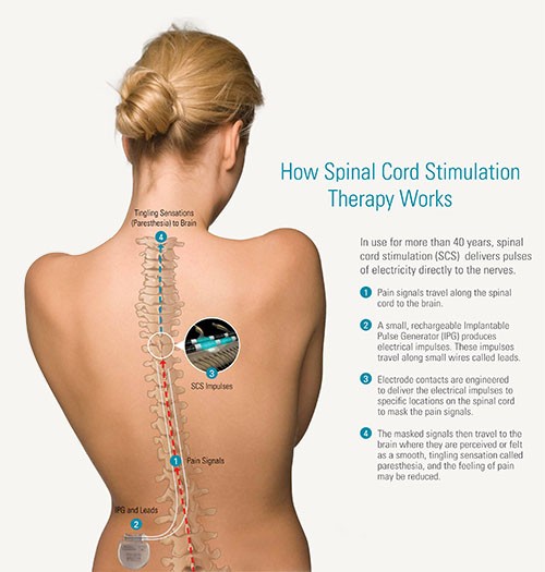 chicago_stem's tweet photo. Spinal Cord Stimulators can be the answer to chronic pain or severe injuries.  

 #painmanagement #workcomp #personalinjurylaw #painmanagement #personalinjury #crushinjury #chronicpainrelief #crps #spinalcordstimulator #abbottmedical  #BostonScientific #medtronic https://t.co/xtrILUw2cO