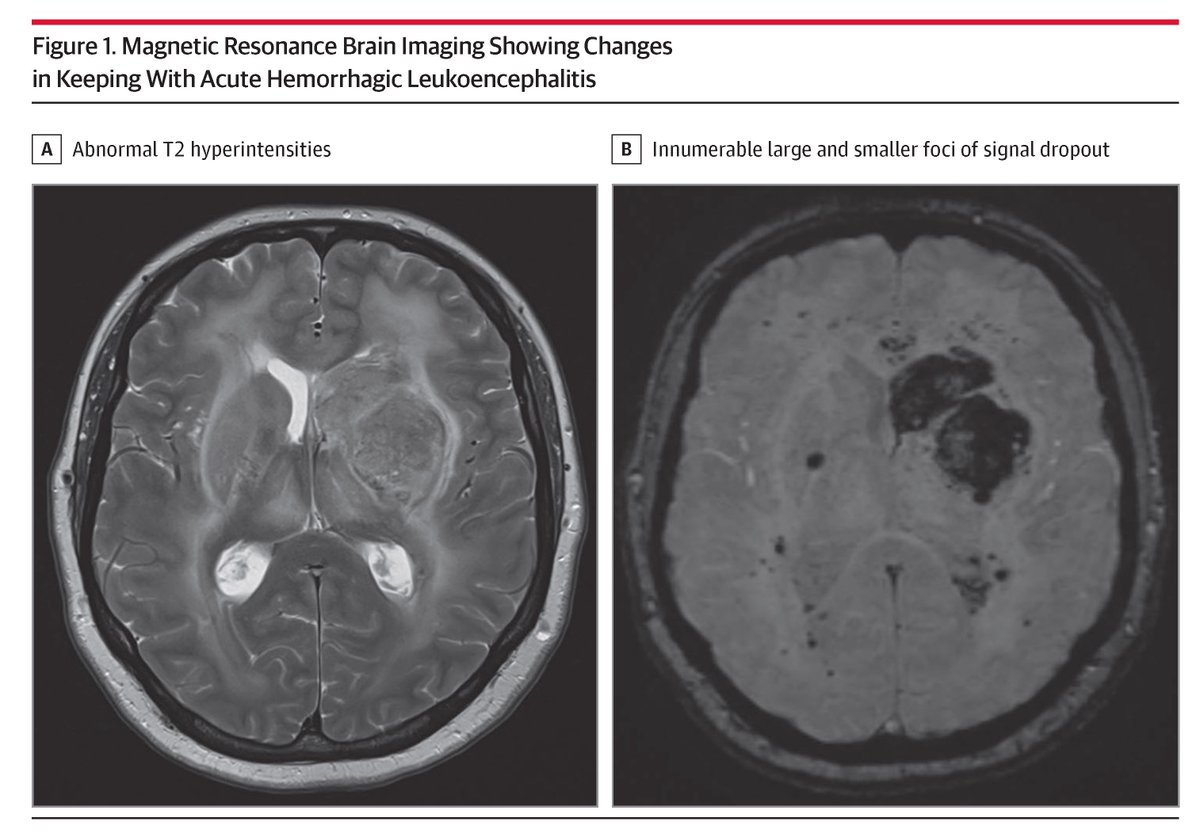 HHV-6 was identified as a rare cause of fulminant acute hemorrhagic leukoencephalitis in an immunocompetent adult. 

ja.ma/4habZHr