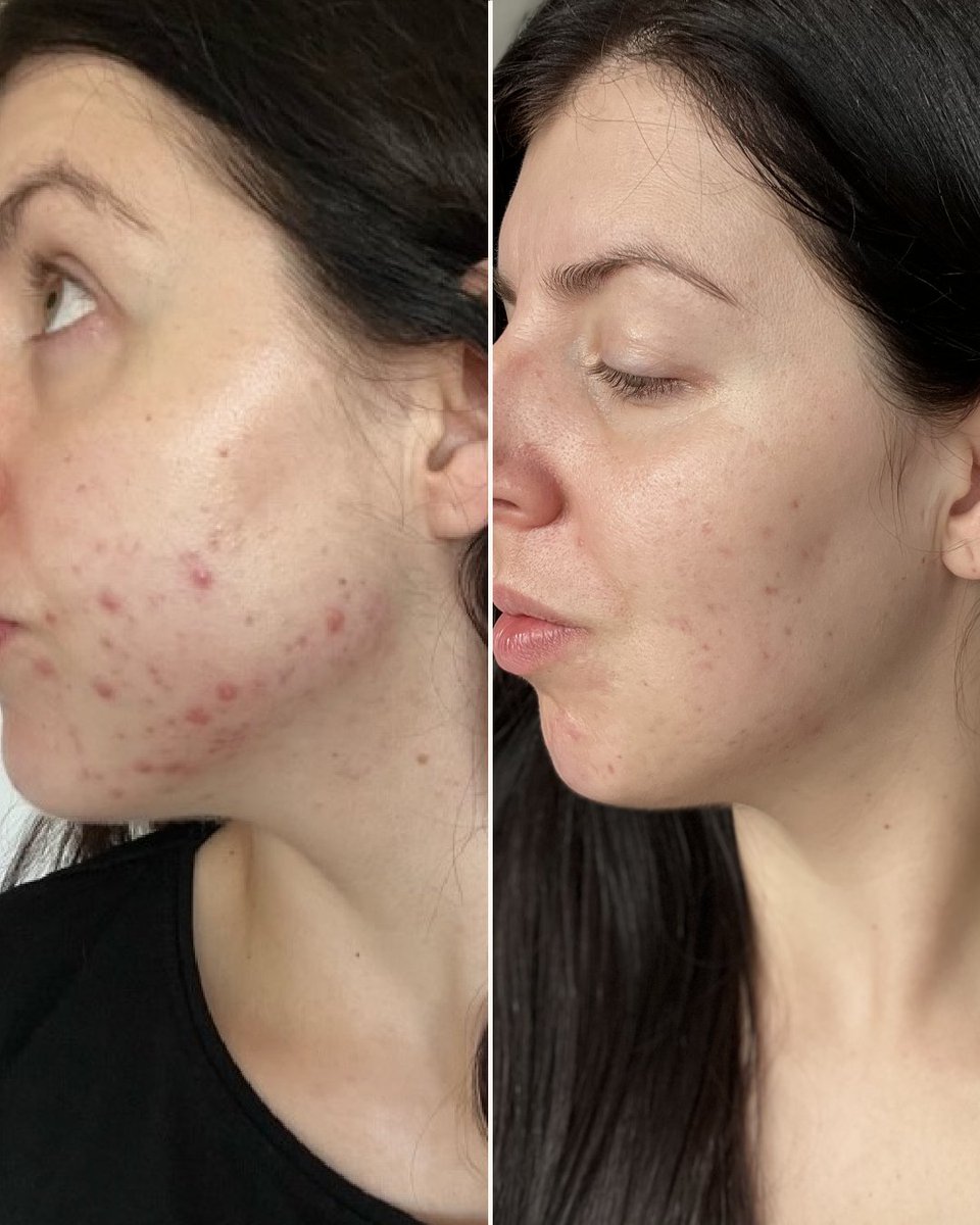 🗣Name: Joanna
❤️Skin concern: Acne
⏰Treatment length: 7 months