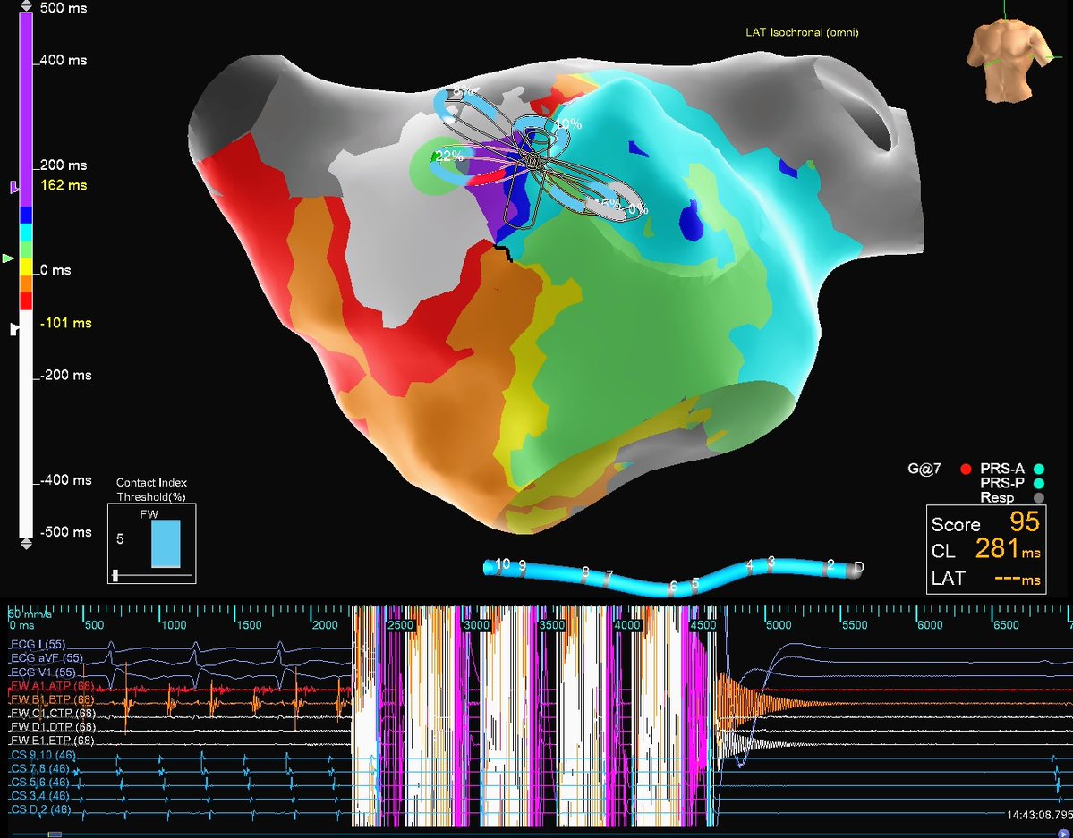 Hapa_EP's tweet image. Some believe PFA can have a local cardioversion effect, but we got a satisfying termination ⚡ in the common isthmus nonetheless! The question is, should we continue this line down to the valve if mitral flutter cannot be induced afterwards or just leave it be? We left it be 😵💫
