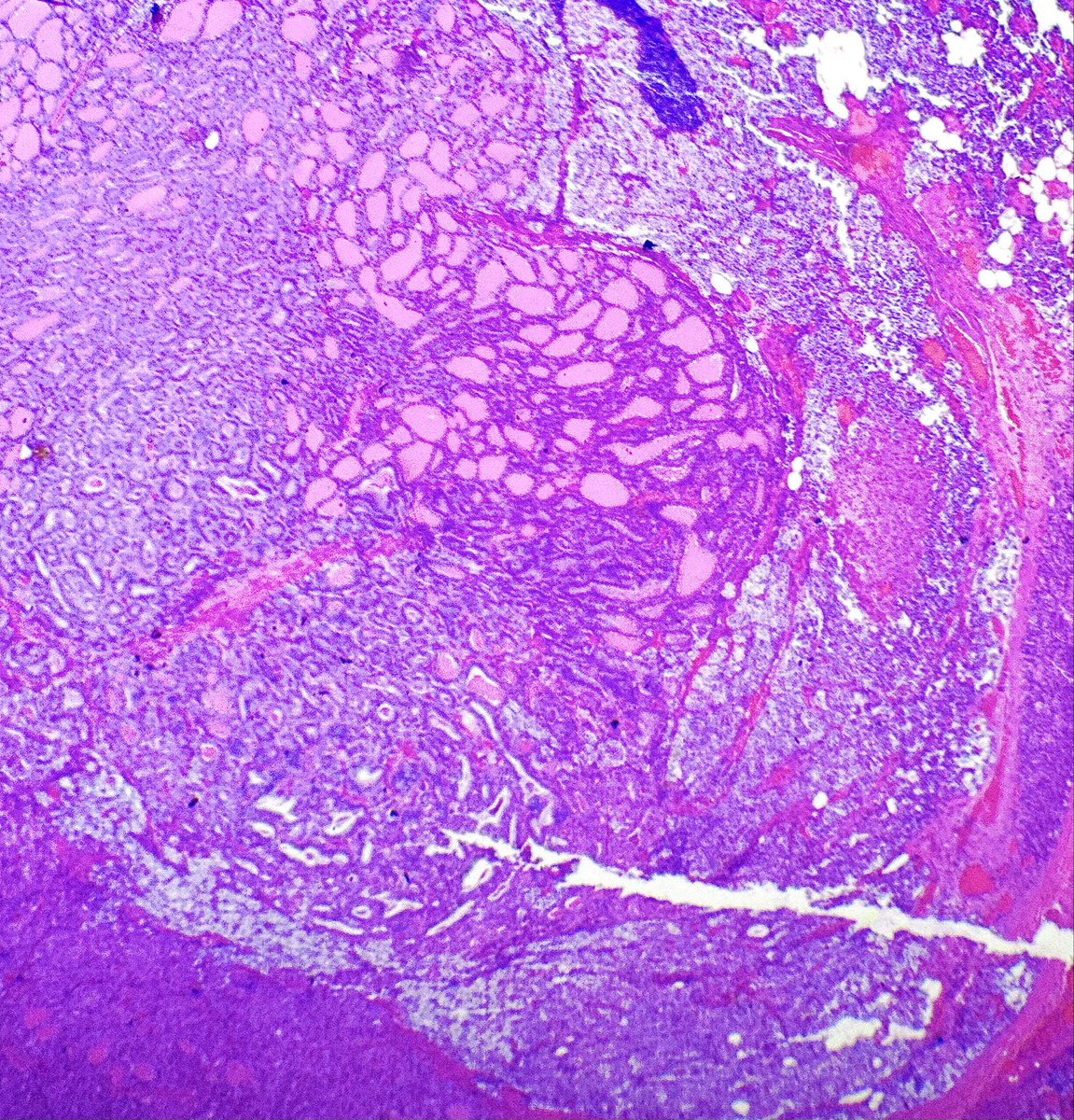 SaraAminMD's tweet image. When PTC decide to hang out with intrathyroidal parathyorid gland 😍
