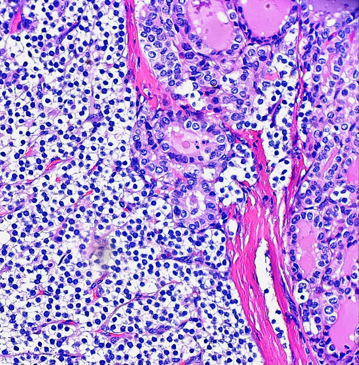 SaraAminMD's tweet image. When PTC decide to hang out with intrathyroidal parathyorid gland 😍
