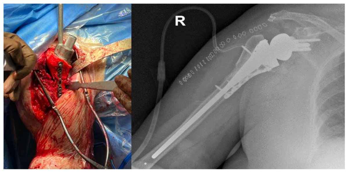 JPM_MDPI's tweet image. 🐋 Don&apos;t miss out this review! #mdpijpm

&quot;Allograft #Prosthesis Composite (#APC) for Proximal Humeral Bone Loss: Outcomes and Perspectives&quot;

🏥 Fondazione Policlinico Universitario Campus Bio-Medico
💡 Enjoy reading: mdpi.com/2075-4426/13/9…

#ShoulderReplacement #Orthopedics