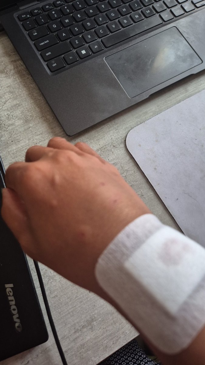 I was attacked by Pitbull yesterday! I'm feeling sorry for myself 😪