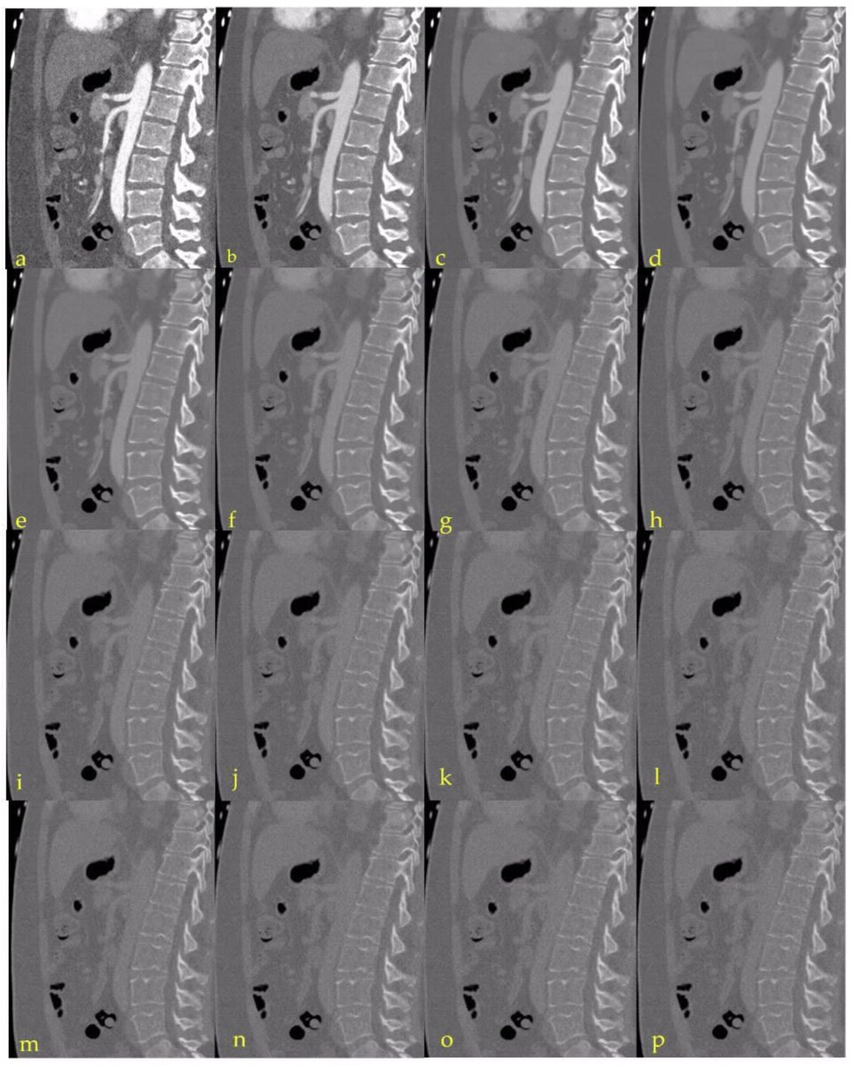 diagnostic_mdpi's tweet image. #highlycitedpaper #CT #diagnostics
"Impact of CT Photon-Counting Virtual Monoenergetic Imaging on Visualization of Abdominal Arterial Vessels"
by Daniel Dillinger et al.
✨32 citations
📄Read the complete paper online or download the PDF at mdpi.com/2075-4418/13/5…