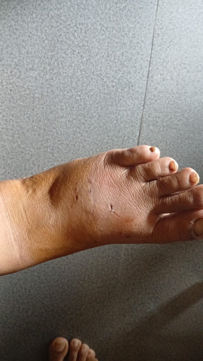 JustBFriendly's tweet photo. Rabies Alert: Geetanagar, Ghy
7 Oct-A rabies case has been confirmed in a cat that bit two people. The cat tested rabies positive at Khanapara Vet College.
Bite victims have received PEP.
Report strange animal behavior: 97060 49585
Vaccinate your pets.

#RabiesAlert #OneHealth https://t.co/pTZm0inSfc