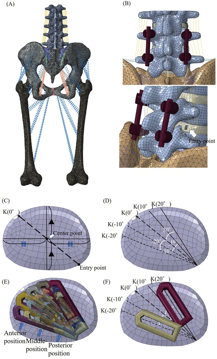 nmc_jns's tweet image. New Arrival: Biomechanical Effects of Cage Position in Full-endoscopic Trans-Kambin's Triangle Lumbar Interbody Fusion: A Finite Element Analysis
doi.org/10.2176/jns-nm…
#SpineAndSpinalCordSurgery #FiniteElementAnalysis #BiomechanicalStudy #FullEndoscope…