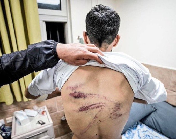 AbujomaaGaza's tweet image. Dr Mohammed abu Salmiya, general Director of Al Shifa Hospital:

▪️Palestinian hostages freed from Israeli torture camps are exhausted and show clear signs of torture.
▪️Some of them had their limbs amputated.
▪️Many of them were wounded before or during their kidnapping, and…