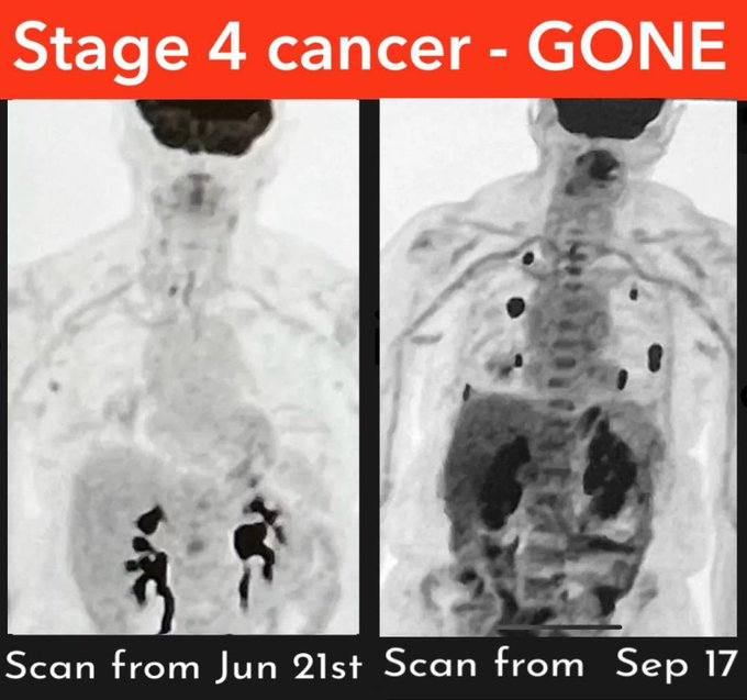 _Ivermectincure's tweet photo. 🚨 Stage 4 Cancer… Gone in 3 Months — A Remarkable Recovery Story

A 73-year-old woman was told there was nothing more doctors could do. Stage 4. No cure.

@_Ivermectincure 

��� Yet just 90 days later, her scans showed no detectable disease.

What changed?

Her son began researching natural support strategies and came across information about IP6 (Inositol Hexaphosphate), nutrient-rich juicing, Mesima mushrooms, and Ivermectin as part of a broader wellness approach.

Here’s what she incorporated into her daily routine ⬇️

• 🥄 IP6: 2 scoops, twice a day on an empty stomach
• 🥕 Carrot & vegetable juices: about 24 oz daily
• 🍄 Mesima mushroom & olive leaf extracts
• 💉 3 immunotherapy sessions (her doctors advised it likely wouldn’t be curative)
• 💊 Ivermectin: added later as a complementary measure

⚡ No chemotherapy. No radiation. No fenbendazole.
Three months later — complete remission.
This isn’t an isolated story. More people are reporting similar recoveries after combining integrative nutrition, immune support, and conventional care. Early research and case reports suggest these natural compounds may have promising anticancer potential, though more studies are needed.
People deserve to explore every possible avenue for healing.

(And yes… let’s just say Big Pharma might not be too thrilled 😉)