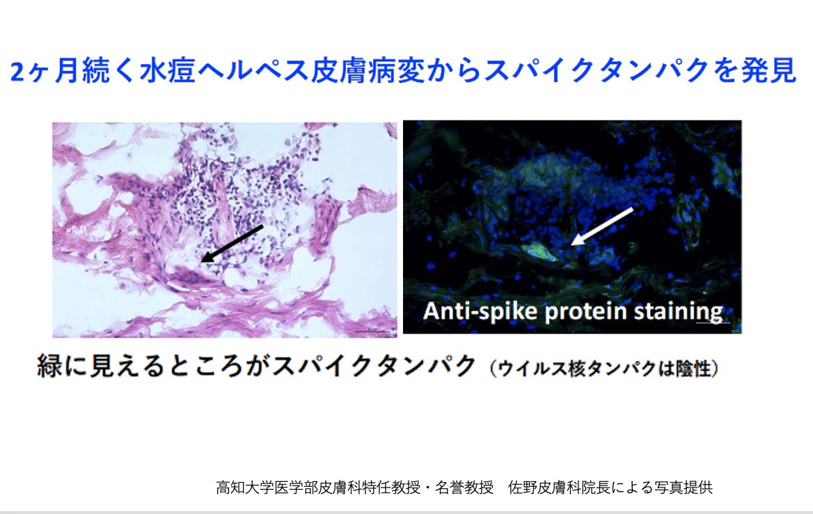 rocio0825's tweet image. 【帯状疱疹の患部にワクチン由来の成分】…