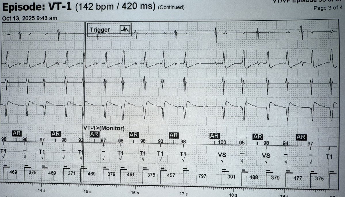 Mazda Motallebi MD FACC FHRS (@mazdamot04) on Twitter photo Device Clinic EP fun time 
PVC / VT ? 
Double Fire (courtesy of <a href="/ALFIEEP1/">ALBERTO ALFIE</a> )
Thoughts?
<a href="/SergioPinski/">Sergio Pinski</a> 
#Epeeps Device Clinic EP fun time 
PVC / VT ? 
Double Fire (courtesy of <a href="/ALFIEEP1/">ALBERTO ALFIE</a> )
Thoughts?
<a href="/SergioPinski/">Sergio Pinski</a> 
#Epeeps