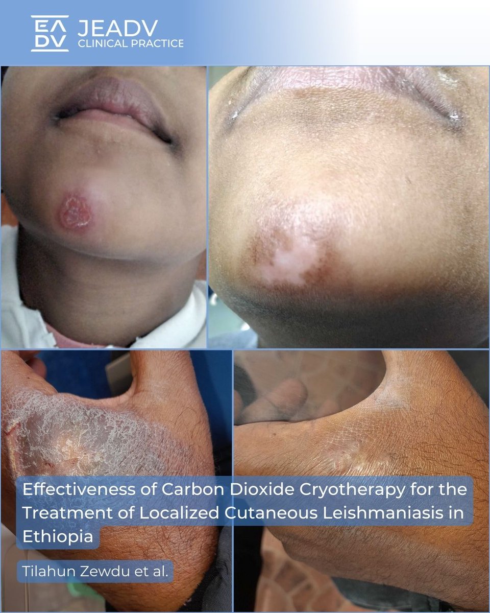 In their Short Report, Tilahun Zewdu et al. explore CO₂ #cryotherapy for #cutaneous #leishmaniasis in #Ethiopia. 

💡 Widely available &amp; practical where liquid nitrogen is scarce.

📊 82.4% healed by Day 90. Promising, but needs formal evaluation. 

👉 bit.ly/45DQt8O