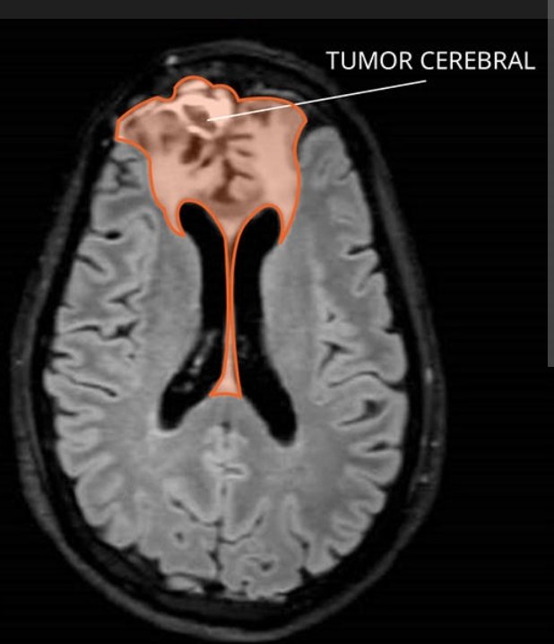 En la #UniversidadDeSevilla cada día entendemos mejor los oligodendrogliomas, un tipo raro de tumor cerebral con mutaciones en IDH y pérdida 1p/19q. Avanzamos hacia diagnósticos más precisos y tratamientos personalizados que mejoran la vida de los pacientes.
 #CáncerCerebral