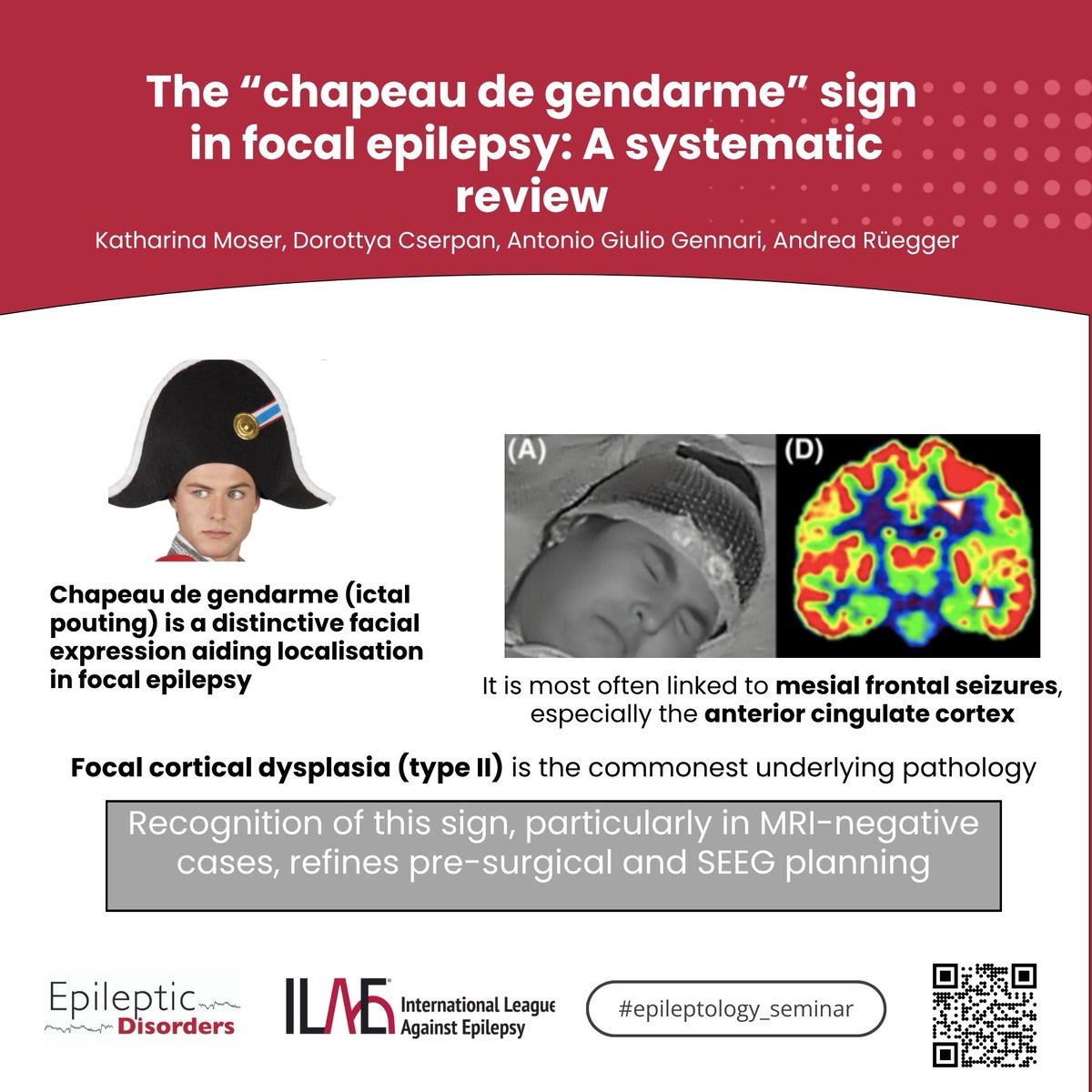 The “chapeau de gendarme” sign is a distinctive facial expression that helps localize seizure onset in focal epilepsy
Read the open-access article- onlinelibrary.wiley.com/doi/10.1002/ep… <a href="/SBeniczky/">Sandor Beniczky</a> <a href="/joanajribeiro/">Joana Ribeiro</a> <a href="/DavidManchala/">#bb招商|#.欧洲杯|#开云体育app|#盲人足球|#DG视讯</a> <a href="/SheikhISMD/">irfan sheikh 伊凡</a> <a href="/AnphyLab/">The AnPhy Lab</a>