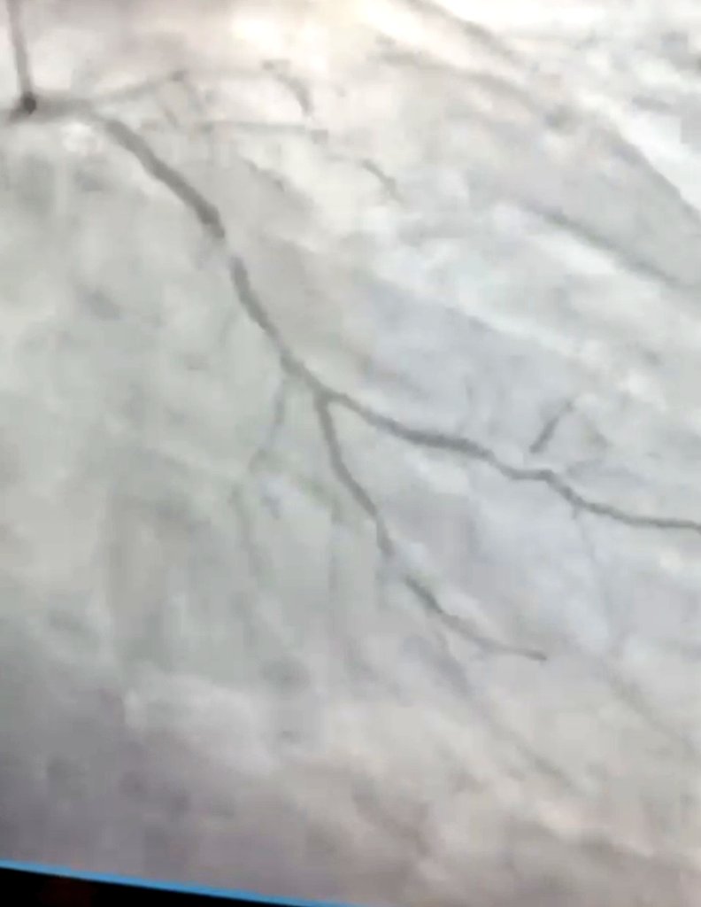 ALNEMERK's tweet image. ضحيةٌ جديدة أُصيبت بجلطةٍ في القلب فجر هذا اليوم بعد أن أوقفت دواء الكوليسترول (الستاتين) نتيجةَ معلوماتٍ مضللةٍ وغير مسؤولةٍ انتشرت في وسائل التواصل الاجتماعي.
هذا الدواءُ المعتمدُ من الجهات الرسمية أصبح للأسف محلّ تهكُّمٍ وسخرية، ففقد بعض الناس الثقة به وأُصيبوا بالضرر.…