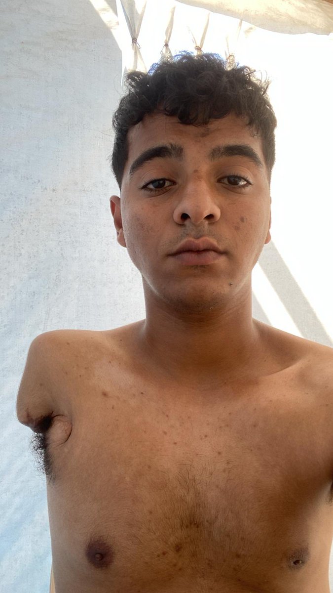 My medical evacuation application has been approved, but I am waiting for acceptance from a country where I can receive treatment.

I need surgery to repair tendons in my foot and I need a prosthetic arm 🦾 

Please help me get the treatment I desperately need 🙏