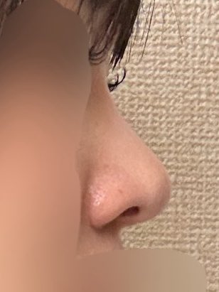 ShiroButaUsagi's tweet photo. 鼻フル整形DT6ヶ月
もう半年経った〜！低くなったとかも特になし！前までは自分の鼻を毎日気にしてたけど気することがなくなった嬉しい🥹
小鼻の傷は自然光に当たるとやっぱ分かるけど、形は満足だから後悔なし！本当に整形やって良かった
#ビギン美容外科 #イジュチョル院長 #渡韓 https://t.co/wGrjMhqHIq