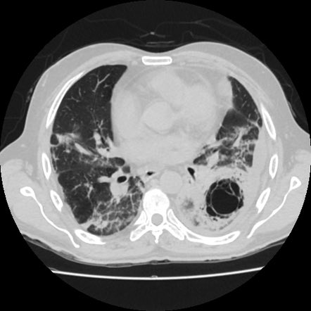 NicoGagelmann's tweet image. Here is a CT of an immunocompromised patient with recurrent dyspnea and fever. Diagnosis?