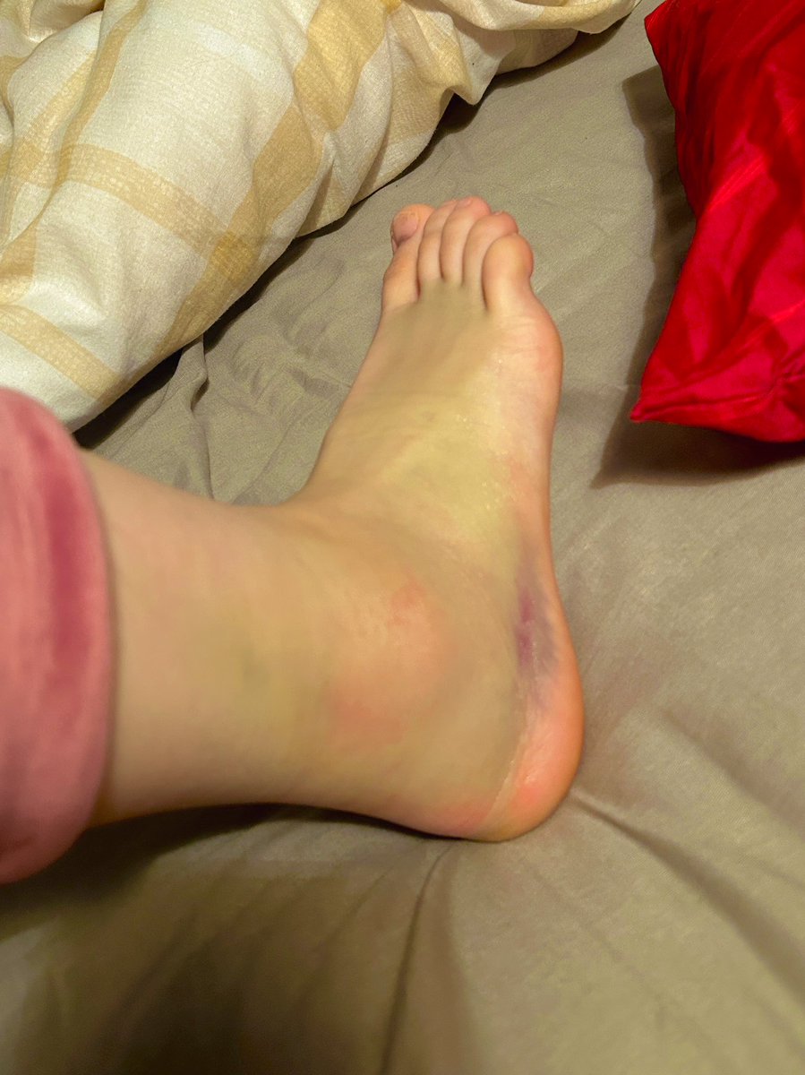 emys__art's tweet image. | help needed | comissions open! |

please take a moment to read this post and retweet/tell your friends about it if you can. Any help would be so appreciated ❤️‍🩹

To comission me, DMs are open! Otherwise, the link is in my bio!

(warning for photos: very green ankle as proof!)